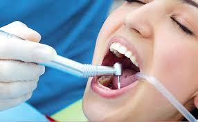 What your dentist needs to know before a tooth extraction: Tooth Fillings In Auckland Otahuhu Dental Natural Tooth Coloured Fillings Maxcare Dental