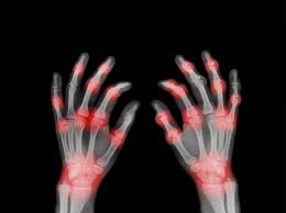 Share a gif and browse these related gif searches. Why Do My Joints Hurt 10 Joint Pain Causes You Should Know