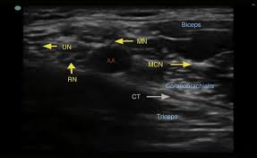 Image result for Axillary Nerve Block