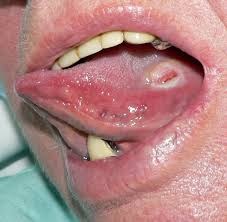 Image result for Puchýře na jazyku