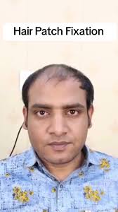 Hair Patches Fixation Service Available In Our Store. Connect Us At  9803887191/9803331228 Instagram : Stopshopnepal #hair #hairstyle  #hairfixation #hairpatch #malehair #hairtok #hairtutorial