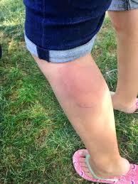 Bug Bites That Look Like Mosquito Bites But Hurt Pin On Salud