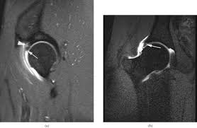 Image result for Hip Labral Tear