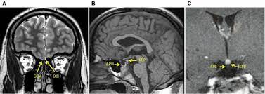 Pituitary Stalk Interruption And Olfactory Bulbs Aplasia Hypoplasia In A Man With Kallmann Syndrome And Reversible Gonadotrope And Somatotrope Deficiencies Springerlink