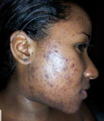 Lets talk acne and its complications – Skinandall