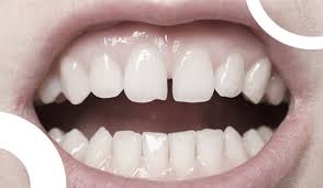 Le mal de dent peut être passager et léger ou se transformer en une véritable rage de dent dans laquelle la douleur est pratiquement insupportable. Problemes De Gencives Qui Se Retractent Dr Ari Elhyani Chirurgien Dentiste