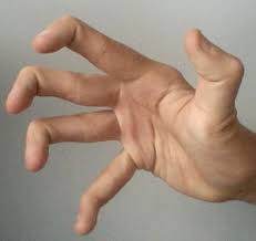 Actually stretching the fingers and toes is meant to help…. Hypermobility Joints Wikipedia