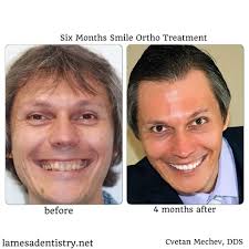 Six Month Smiles La Mesa 91942