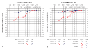 Image result for Whispered Voice Testing