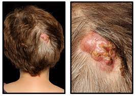 Some dogs will develop multiple cysts along the ears or around the anus. Case Report A Rapidly Growing Cyst On The Scalp F1000research