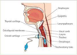 Nursing Care Of Patients With A Temporary Tracheostomy