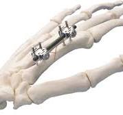 Mini External Fixator | Products | DePuy Synthes