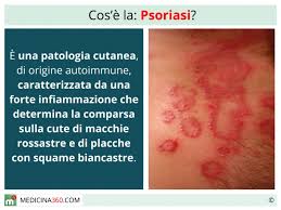 I sintomi variano in base alla malattia che compare e alla parte del corpo interessata. Psoriasi Tipi Cause E Cure