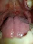 Image result for Physical injury red spots roof of mouth