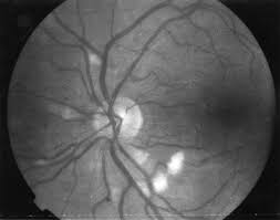 Image result for HIV Retinitis