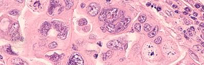 I left mine for years and by the time i got to the doctors and finally had all the tests i needed i had type 2 stage of ovarian cancer due to a tumor that was growing from the inside of my ovary and attached itself to my tummy. Ovarian Cancer Patient Care