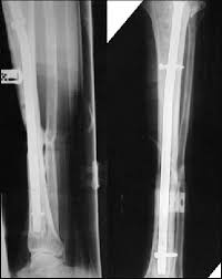 Information was collected using a standardized questionnaire. Plain Radiographs Showing United Tibia And Fibula Fractures With An Download Scientific Diagram