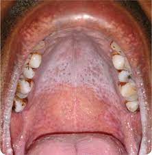 The causes can range from simple ginigivitis to mouth cancer (don't get scared, that's a slim chance). Lesions On The Roof Of The Mouth Photo Quiz American Family Physician