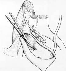 Sında politano leadbetter yöntemi ile ameliyat edilen 63. Simplified Politano Leadbetter S Ureteral Reimplantation Associated With Psoas Hitch Technique Using A New Clamp Sciencedirect