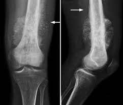 A swelling, lump or mass may develop in the leg if bone cancer is present. Osteosarcoma Orthoinfo Aaos