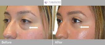 Lower Blepharoplasty Before And After Gallery | Taban Md