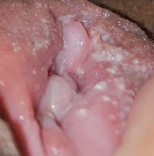 Woman experiences pain in perineum. White Bumps Inside Vaginal Opening Serious Yeast Infection Or Herpes Candida Genital Forums Patient