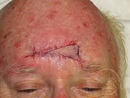 28.01.2020 · basal cell carcinoma's are the most common form of skin cancer and happen frequently in fair skin people with a lifetime of sun exposure. Forehead Reconstruction 4 Skin Cancer And Reconstructive Surgery Center