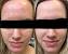 Nizoral Shampoo Hair Loss Before After