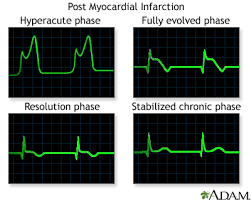 Tests your doctor may recommend include: Post Myocardial Infarction Ecg Wave Tracings Medlineplus Medical Encyclopedia Image