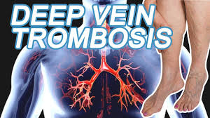 You can develop this potentially serious condition, with few or no symptoms. Trombosis Vena Darah Menggumpal Di Kaki Wajib Anda Waspadai Youtube