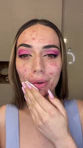 The Power of Acceptance for Clearer Skin and Mind