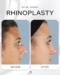 Rhinoplasty x Dr. Godek This patient's transformation is the result of Dr.  Godek's skillful rhinoplasty technique, designed to enhance and balance the  nose with the rest of the face—achieving subtle, natural results.