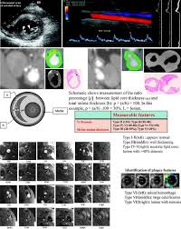 The internal carotid artery (latin: Evaluation Criteria Of Carotid Artery Atherosclerosis Noninvasive Multimodal Imaging And Molecular Imaging Springerlink