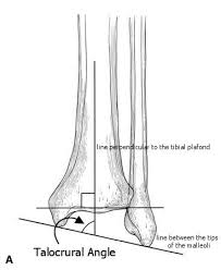 Want to learn more about it? Ankle Fractures Trauma Orthobullets
