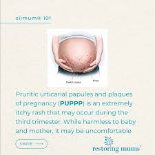 Image result for pruritic urticarial papules and plaques of pregnancy