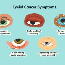 Periocular skin cancer(skin cancers around eyelid area) the most common skin cancers in the eyelid area are basal cell carcinoma, squamous cell carcinoma, melanoma and sebaceous cell carcinoma. Eyelid Cancer Overview And More