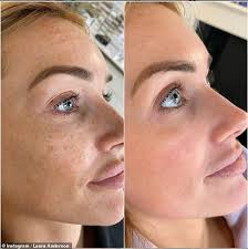 Human skin contains melanocyte cells that produce melanin, a pigment found in the skin, hair and eyes, through a process called melanogenesis. Love Island S Laura Anderson Corrects Her Pigmentation With A Facial Peel Daily Mail Online