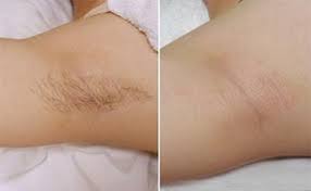 Imagine plucking of the hair, laser and waxing, that hurt, and yet are classified as a temporary hair removal method. Clean Easy Home Electrolysis Review Hair Removal Home Blog Study Probes Bare Facts Of Waxing