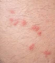 This skin reaction may result in itchy bumps that look like mosquito bites but aren't. 8 Common Bug Bites You Should Watch Out For Wes Moss