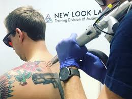 View service > laser facial. Laser Tattoo Removal Education Faqs New Look Laser College