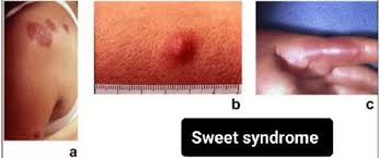 Image result for Nodular Lymphangitis