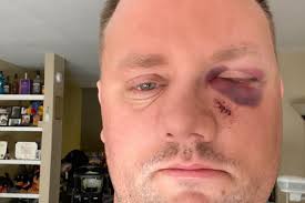 Fundraiser for Matthew Godde by Kelley Godde : Help fix Matt's face