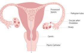 Hcg medication (if necessary) $115. Iui 3 Cycle Package Costs Included And Excluded Concept Fertility