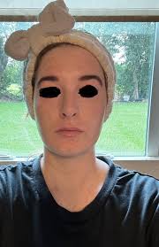 Good evening, I'm looking for recommendations for derma filler, I'm after  my jaw nose and Russian lips before I go away next month, side profile  balancing 🙏 any good recommendations thank you