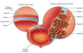 Tratament Adenom De Prostata Sau Prostata Marita Dr Gheorghe Nita
