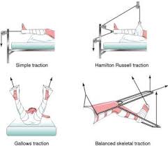 Types Of Traction Pediatric Nursing Nursing Information Medical Surgical Nursing