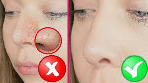 как очистить лицо от черных точек в домашних условиях содой Glubokaya Chistka Lica Za 1 Proceduru V Domashnih Usloviyah Piling Youtube