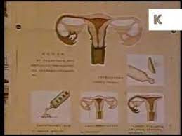 In 1970, 13% of married women used modern contraceptivemethods, which rose to 35% by 1997 and 48% by 2009. Early 1970s China Family Planning Clinic Birth Control Archive Footage Youtube