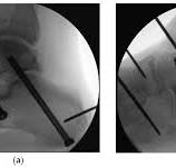 Optimizing Subtalar Arthrodesis: A Human Cadaveric ...