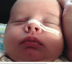 A Neonate With A Crooked Nose Consultant360